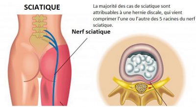 Trois solutions pour soulager la sciatique