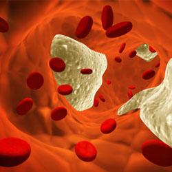 infarctus-causes